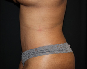 Tummy Tuck Before & After Patient #24557