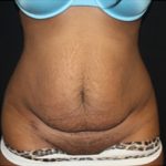 Tummy Tuck Before & After Patient #24557