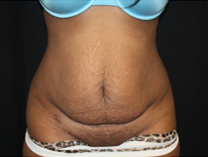 Tummy Tuck Before & After Patient #24557