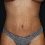 Tummy Tuck Before & After Patient #24557