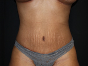 Tummy Tuck Before & After Patient #24557