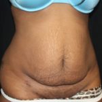 Tummy Tuck Before & After Patient #24557