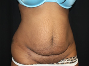 Tummy Tuck Before & After Patient #24557