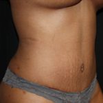 Tummy Tuck Before & After Patient #24557