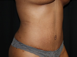 Tummy Tuck Before & After Patient #24557