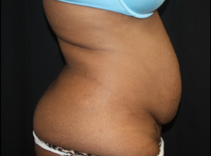 Tummy Tuck Before & After Patient #24557