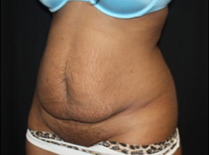 Tummy Tuck Before & After Patient #24557
