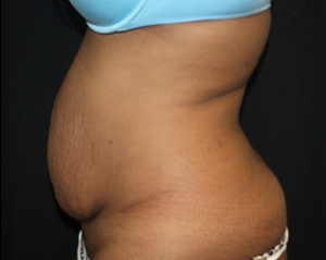 Tummy Tuck Before & After Patient #24557