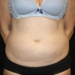 Tummy Tuck Before & After Patient #24558