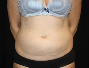 Tummy Tuck Before & After Patient #24558