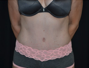 Tummy Tuck Before & After Patient #24558