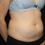 Tummy Tuck Before & After Patient #24558