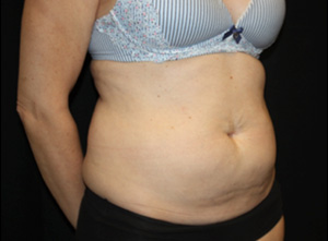 Tummy Tuck Before & After Patient #24558