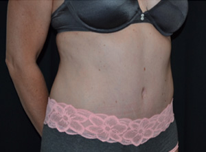 Tummy Tuck Before & After Patient #24558