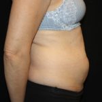 Tummy Tuck Before & After Patient #24558