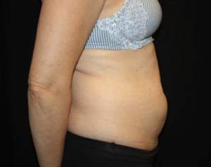 Tummy Tuck Before & After Patient #24558