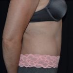 Tummy Tuck Before & After Patient #24558