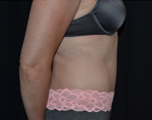 Tummy Tuck Before & After Patient #24558