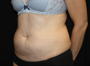 Tummy Tuck Before & After Patient #24558