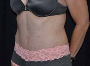 Tummy Tuck Before & After Patient #24558