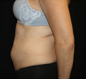 Tummy Tuck Before & After Patient #24558