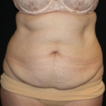 Tummy Tuck Before & After Patient #24580