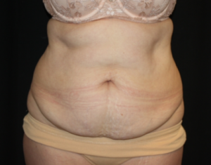 Tummy Tuck Before & After Patient #24580