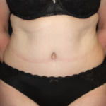 Tummy Tuck Before & After Patient #24580