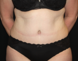 Tummy Tuck Before & After Patient #24580