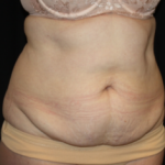 Tummy Tuck Before & After Patient #24580