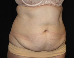 Tummy Tuck Before & After Patient #24580