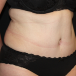 Tummy Tuck Before & After Patient #24580