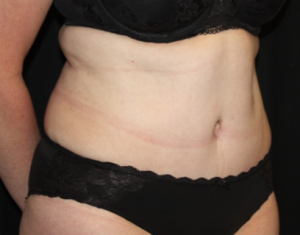 Tummy Tuck Before & After Patient #24580