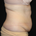 Tummy Tuck Before & After Patient #24580