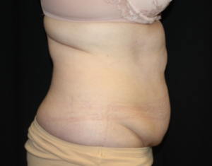 Tummy Tuck Before & After Patient #24580