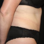 Tummy Tuck Before & After Patient #24580