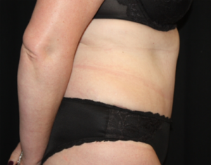 Tummy Tuck Before & After Patient #24580