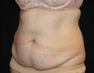 Tummy Tuck Before & After Patient #24580