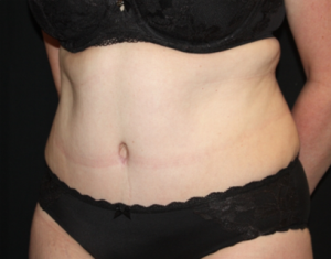 Tummy Tuck Before & After Patient #24580