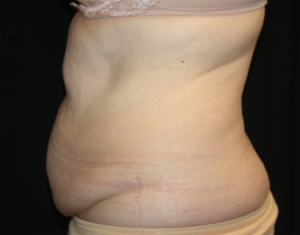 Tummy Tuck Before & After Patient #24580