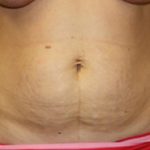 Tummy Tuck Before & After Patient #24581