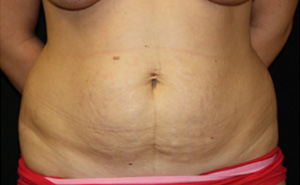 Tummy Tuck Before & After Patient #24581