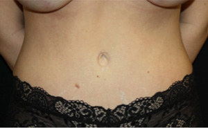 Tummy Tuck Before & After Patient #24581