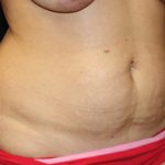 Tummy Tuck Before & After Patient #24581