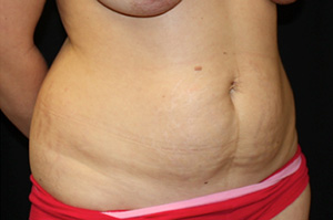 Tummy Tuck Before & After Patient #24581