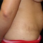 Tummy Tuck Before & After Patient #24581