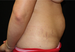 Tummy Tuck Before & After Patient #24581