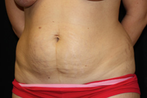 Tummy Tuck Before & After Patient #24581