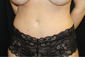 Tummy Tuck Before & After Patient #24581