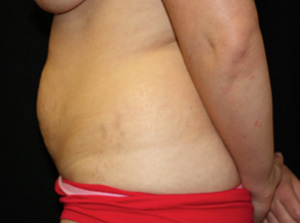 Tummy Tuck Before & After Patient #24581